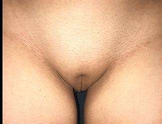 Labiaplasty Before & After Patient #1340