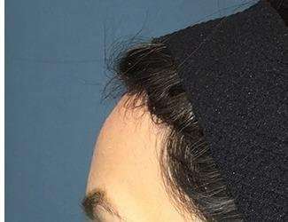 Forehead Reduction Before & After Patient #1364