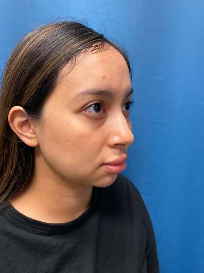 Forehead Reduction Before & After Patient #1371