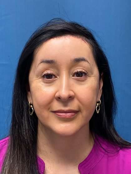 Forehead Reduction Before & After Patient #1376