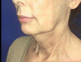 Facial Implants Before & After Patient #1392
