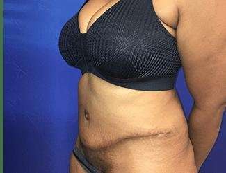 Tummy Tuck Before & After Patient #349