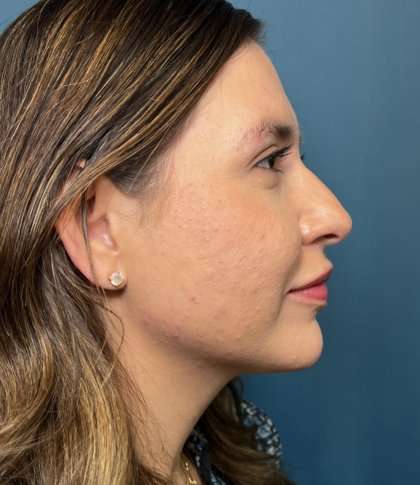 Facial Implants Before & After Patient #1486
