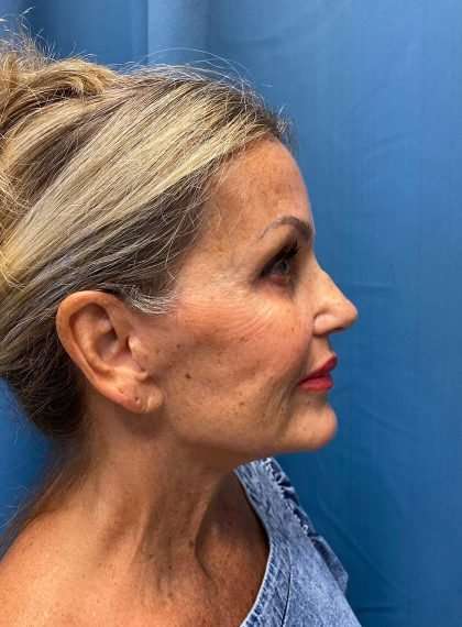 Facelift And Necklift Before & After Patient #1497