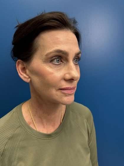 Facelift And Necklift Before & After Patient #1506