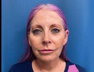Facelift And Necklift Before & After Patient #1520