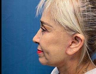 Facelift And Necklift Before & After Patient #1531