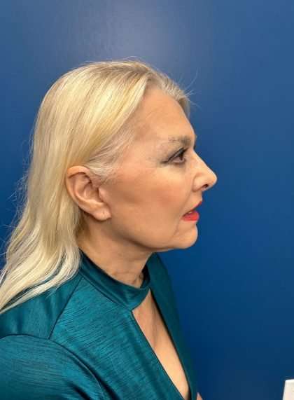 Facelift And Necklift Before & After Patient #1542