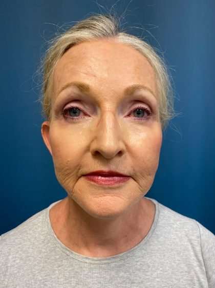 Facelift And Necklift Before & After Patient #1549