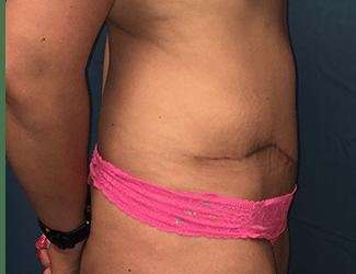 Tummy Tuck Before & After Patient #358
