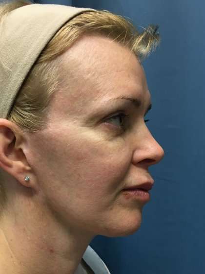 Facelift And Necklift Before & After Patient #1582