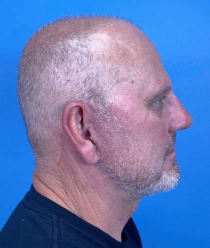 Facelift And Necklift Before & After Patient #1593