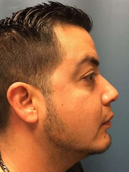 Chin Implant Before & After Patient #1604