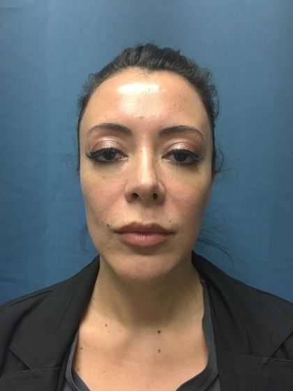 Chin Implant Before & After Patient #1611