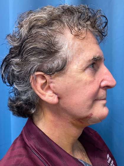 Chin Implant Before & After Patient #1633