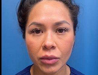 Buccal Fat Removal Before & After Patient #1643