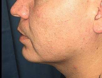 Buccal Fat Removal Before & After Patient #1656