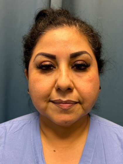 Buccal Fat Removal Before & After Patient #1663