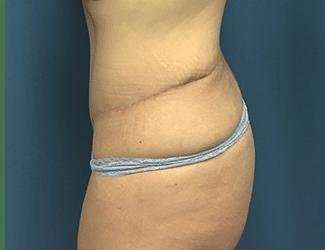 Tummy Tuck Before & After Patient #369