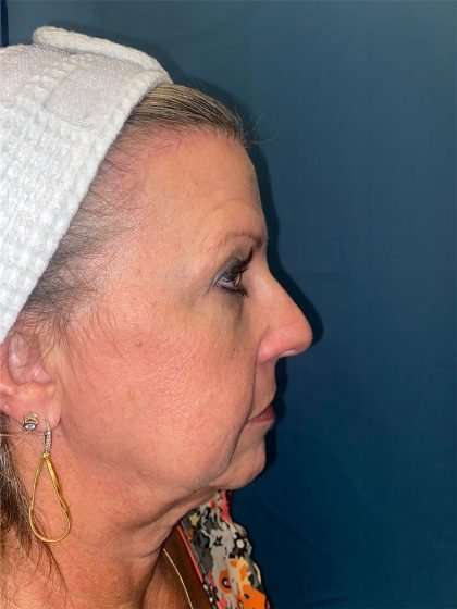 Brow Lift Before & After Patient #1694