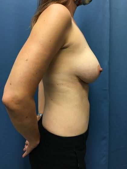 Breast Revision Before & After Patient #1716