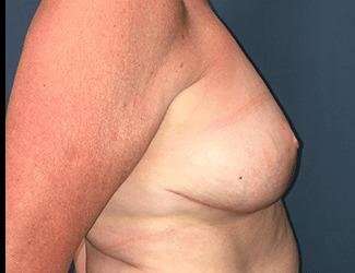 Breast Reduction Before & After Patient #1760