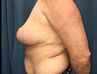 Breast Reduction Before & After Patient #1771