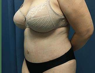 Tummy Tuck Before & After Patient #380