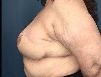 Breast Reduction Before & After Patient #1815