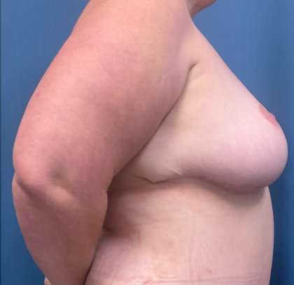 Breast Lift Before & After Patient #1872