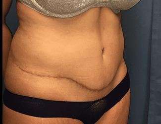 Tummy Tuck Before & After Patient #395