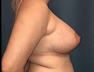 Breast Lift Before & After Patient #1903