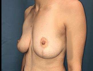 Breast Lift Before & After Patient #1923