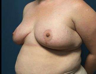 Breast Lift Before & After Patient #1934