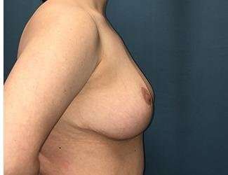 Breast Lift Before & After Patient #1945