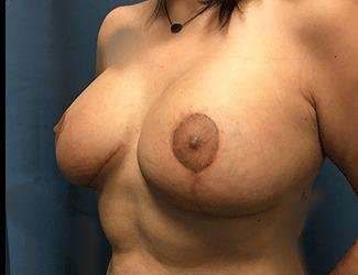 Breast Lift Before & After Patient #1954