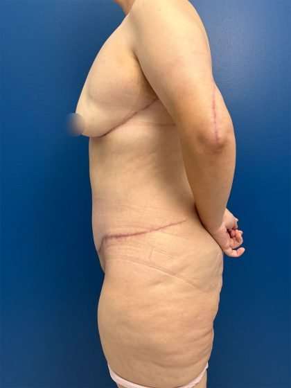 Tummy Tuck Before & After Patient #406