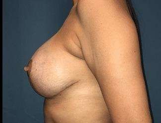 Breast Lift Before & After Patient #2000