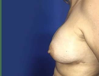 Breast Augmentation Before & After Patient #2069