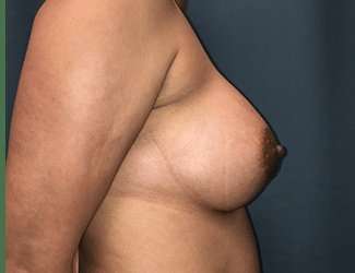 Breast Augmentation Before & After Patient #2080
