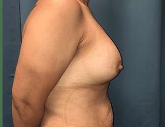 Breast Augmentation Before & After Patient #2091