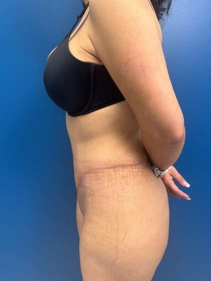 Tummy Tuck Before & After Patient #417