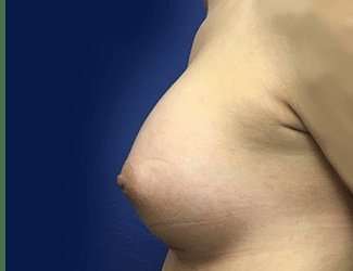 Breast Augmentation Before & After Patient #2102