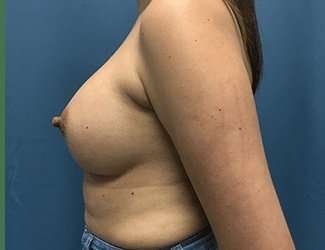 Breast Augmentation Before & After Patient #2133
