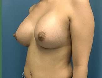Breast Augmentation Before & After Patient #2153