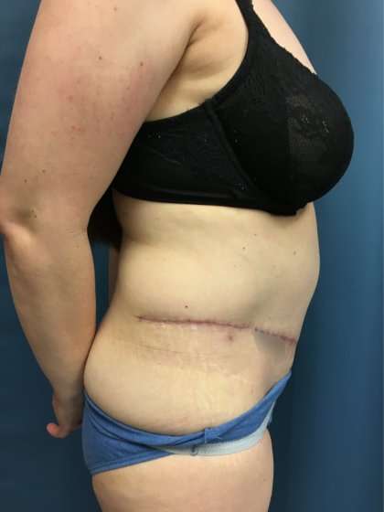 Tummy Tuck Before & After Patient #428