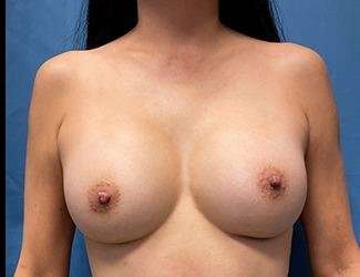 Breast Augmentation Before & After Patient #2220