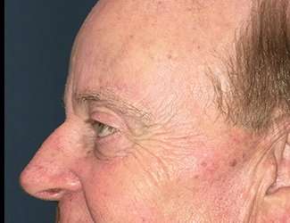 Blepharoplasty Before & After Patient #2251