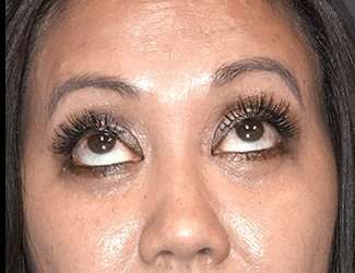 Blepharoplasty Before & After Patient #2260