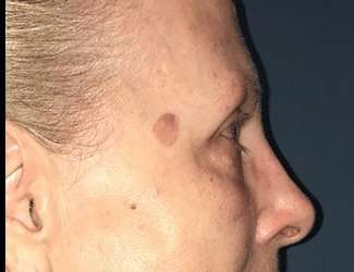 Blepharoplasty Before & After Patient #2271